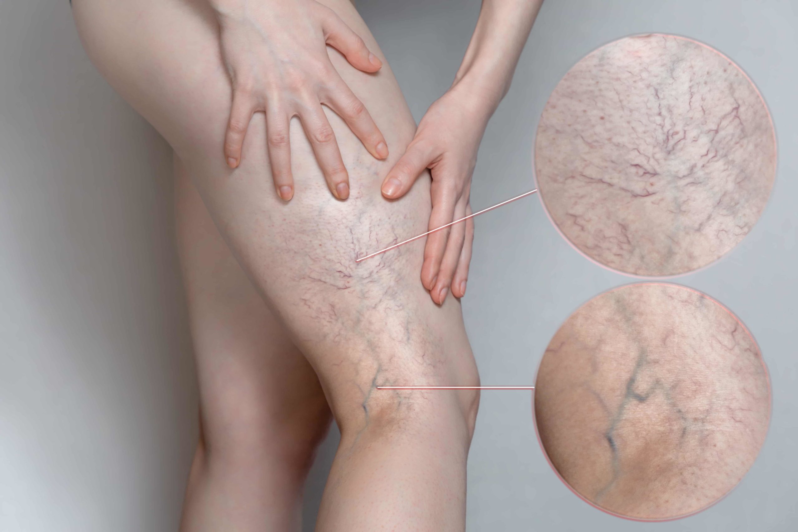 Why Sclerotherapy Might Be Right for You at The Best Injector
