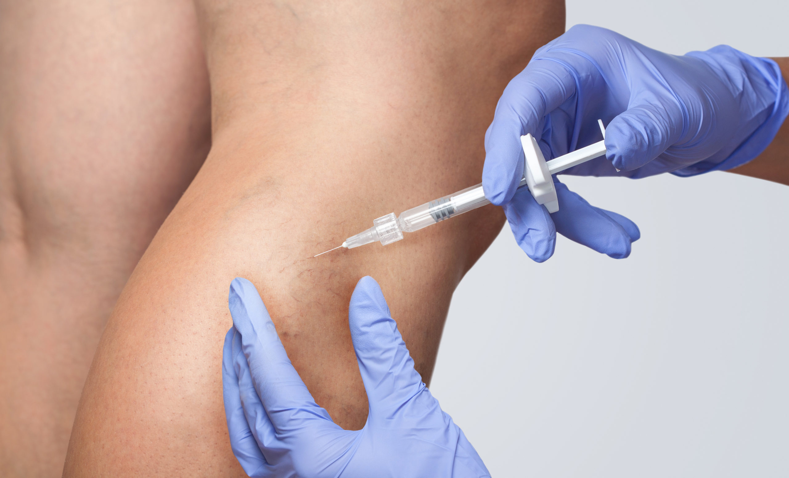 Sclerotherapy: Effective Treatment for Spider Veins at The Best Injector