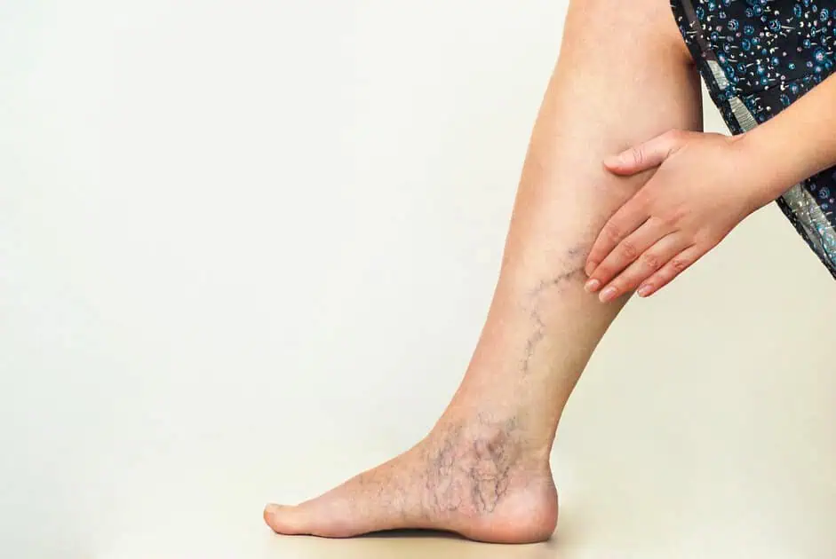Sclerotherapy for Spider Veins by the Best Injector at Delray Beach FL