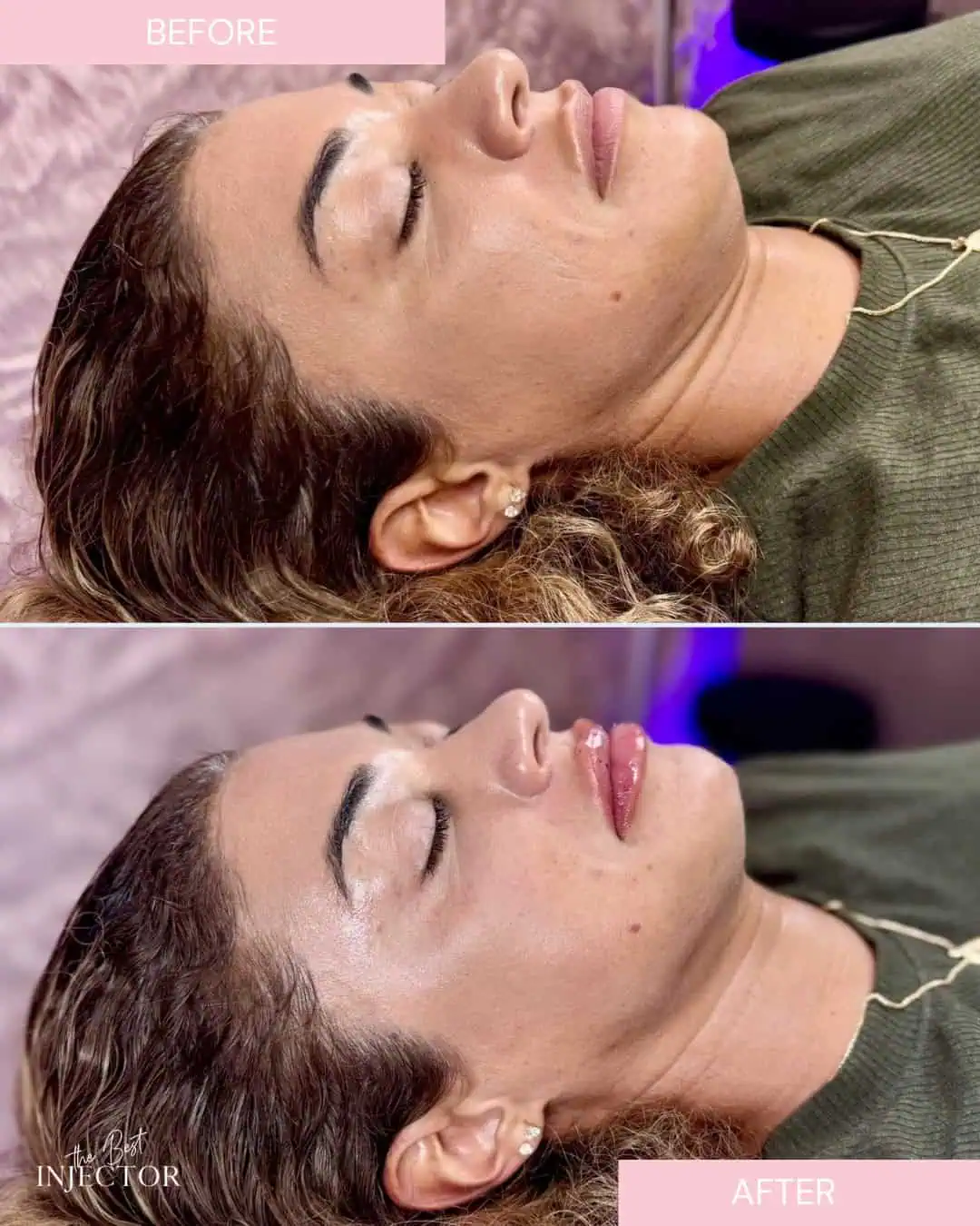 lip-filler-before-after-j
