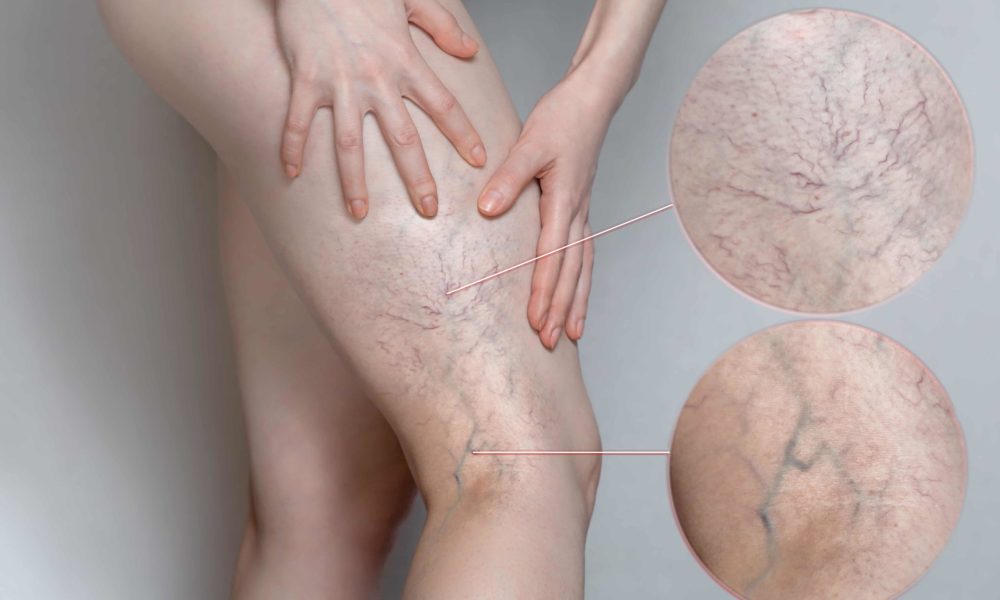 Why Sclerotherapy Might Be Right for You at The Best Injector